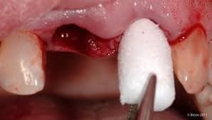 Matrix Derm Collagen Plugs image 1